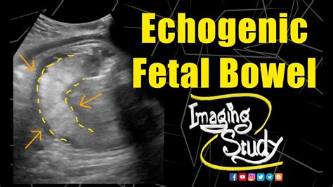 echogenic ultrasound meaning